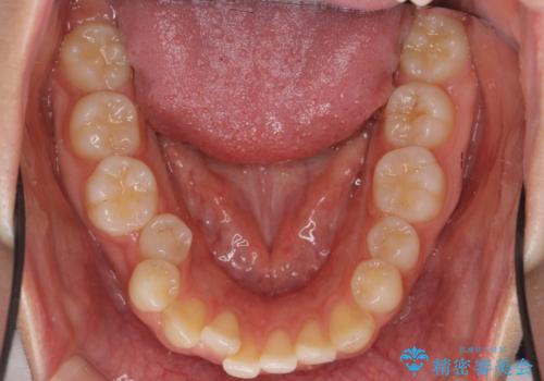 かみ合わせが悪いところを ワイヤー矯正でしっかり治療 マウスピース矯正は難しい症例の治療前