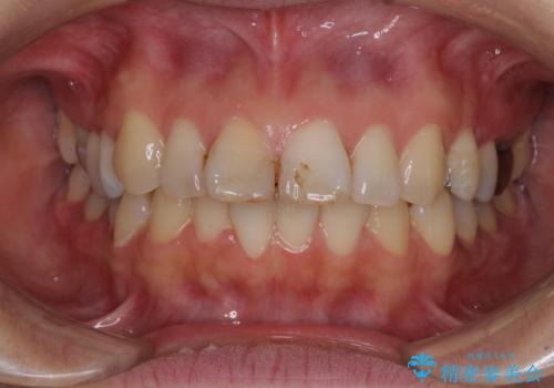 【モニター】前歯のデコボコを治したい インビザラインを用いた矯正治療の症例 治療前