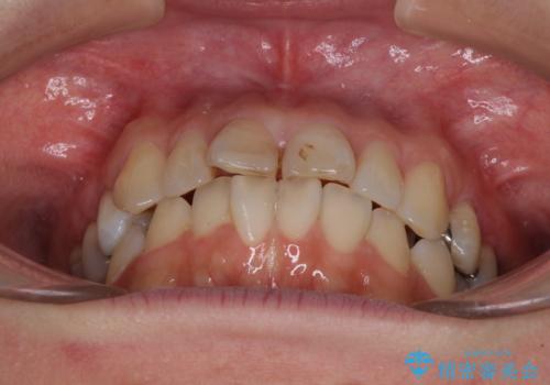 【モニター】前歯のデコボコを治したい インビザラインを用いた矯正治療の治療前