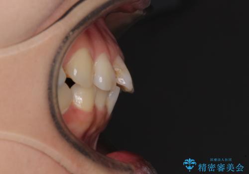 【モニター】前歯のデコボコを治したい インビザラインを用いた矯正治療の治療前