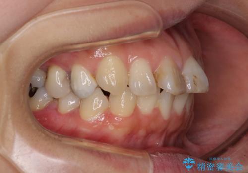 【モニター】前歯のデコボコを治したい インビザラインを用いた矯正治療の治療前