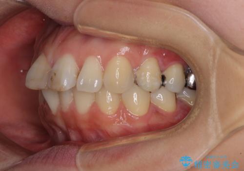 【モニター】前歯のデコボコを治したい インビザラインを用いた矯正治療の治療前