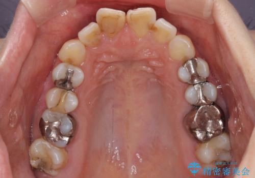 【モニター】前歯のデコボコを治したい インビザラインを用いた矯正治療の治療前