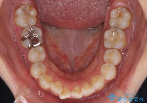 【モニター】前歯のデコボコを治したい インビザラインを用いた矯正治療の治療前