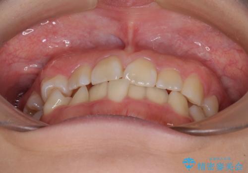 重度叢生と埋もれた奥歯 8本を抜歯したワイヤー矯正の治療前