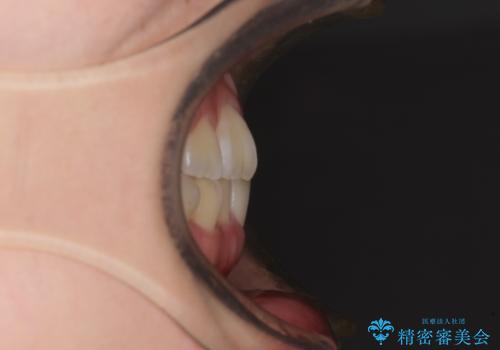 重度叢生と埋もれた奥歯 8本を抜歯したワイヤー矯正の治療前