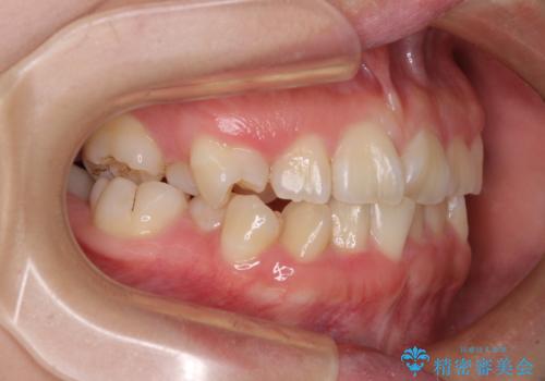 重度叢生と埋もれた奥歯 8本を抜歯したワイヤー矯正の治療前
