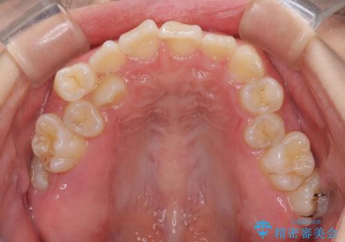 重度叢生と埋もれた奥歯 8本を抜歯したワイヤー矯正の治療前