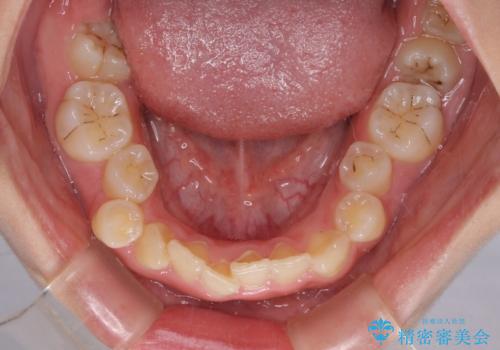 重度叢生と埋もれた奥歯 8本を抜歯したワイヤー矯正の治療前