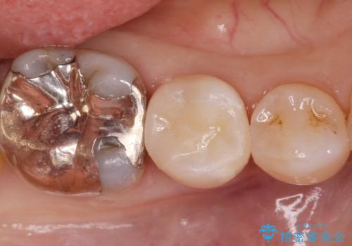口を開けると銀歯が見えるのが嫌だ。の治療後