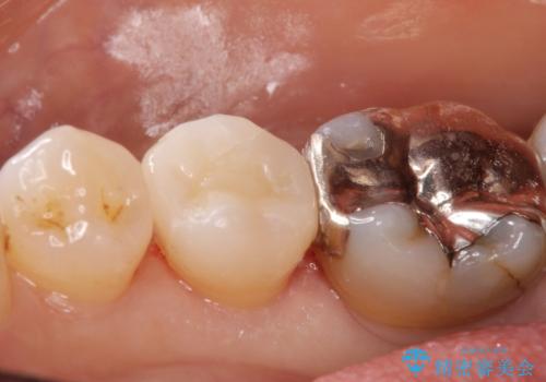 口を開けると銀歯が見えるのが嫌だ。の治療後