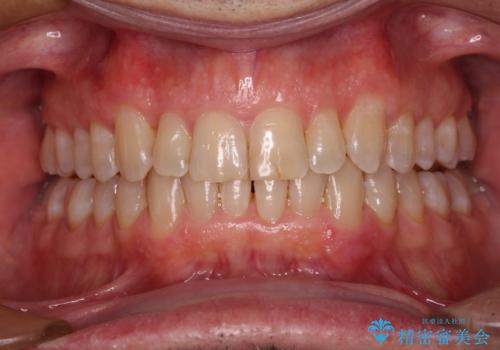 【モニター】前歯のデコボコを治したい インビザライン矯正治療の治療中