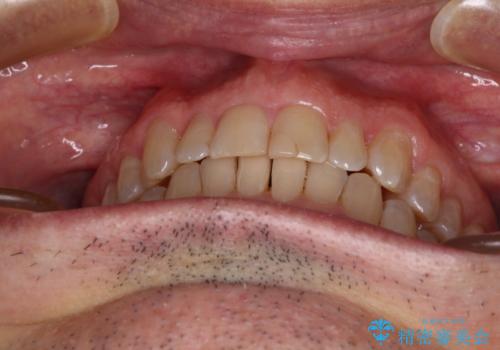 【モニター】前歯のデコボコを治したい インビザライン矯正治療の治療中