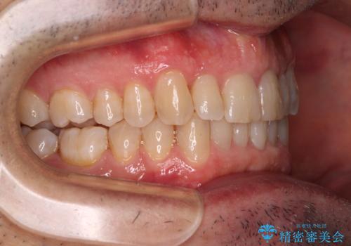 【モニター】前歯のデコボコを治したい インビザライン矯正治療の治療中