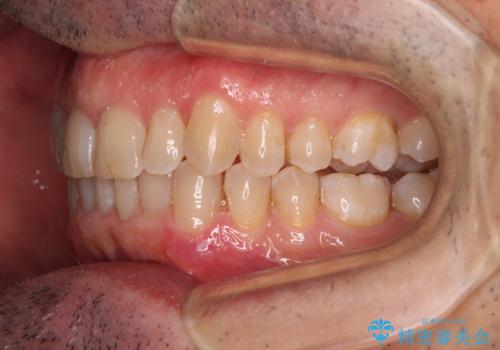 【モニター】前歯のデコボコを治したい インビザライン矯正治療の治療中