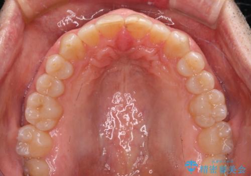 【モニター】前歯のデコボコを治したい インビザライン矯正治療の治療中