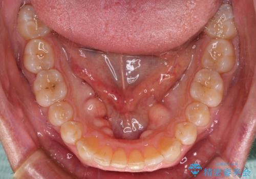 【モニター】前歯のデコボコを治したい インビザライン矯正治療の治療中