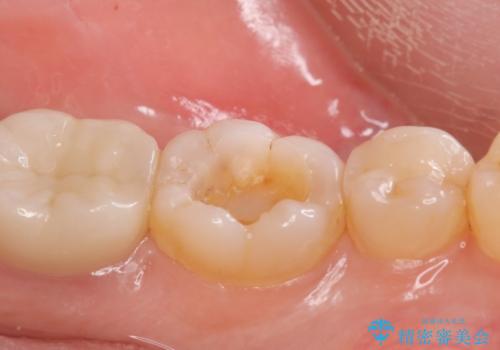 歯の噛む面が黒い。の治療中