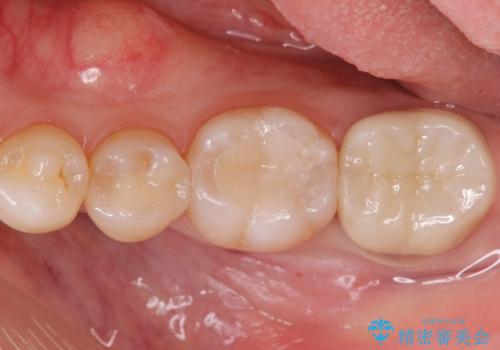 歯の噛む面が黒い。の治療後