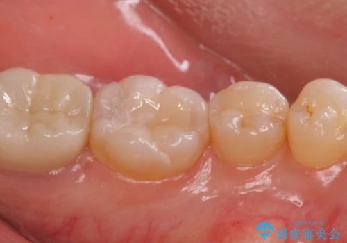 歯の噛む面が黒い。の治療後