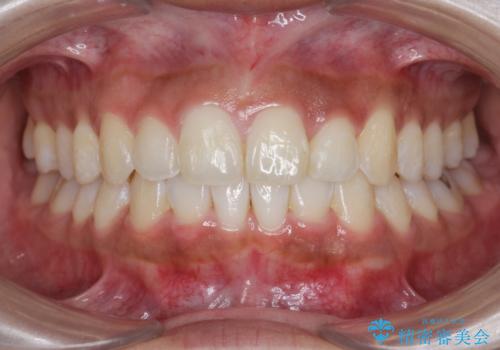 出っ歯感のある前歯を治したい、抜歯をしないマウスピース矯正の治療後