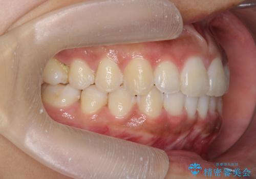 出っ歯感のある前歯を治したい、抜歯をしないマウスピース矯正の治療後