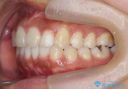 出っ歯感のある前歯を治したい、抜歯をしないマウスピース矯正の治療後
