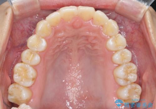 出っ歯感のある前歯を治したい、抜歯をしないマウスピース矯正の治療後