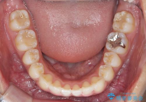 出っ歯感のある前歯を治したい、抜歯をしないマウスピース矯正の治療後