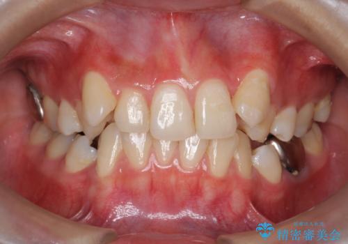親知らずを生かした矯正の症例 治療前