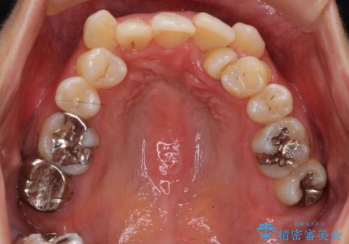 親知らずを生かした矯正の治療前