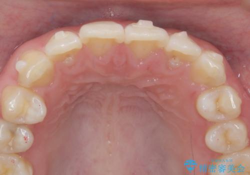 [ インビザラインライト ]   14枚で行う前歯のみの短期間マウスピース矯正の治療中