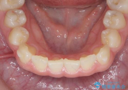 [ インビザラインライト ]   14枚で行う前歯のみの短期間マウスピース矯正の治療中