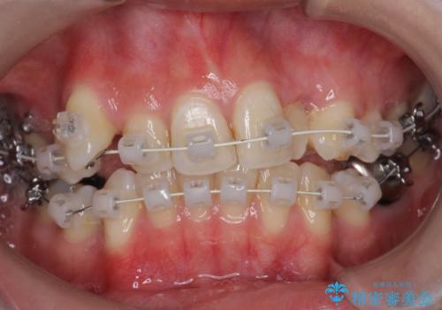 親知らずを生かした矯正の治療中