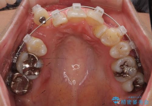 親知らずを生かした矯正の治療中