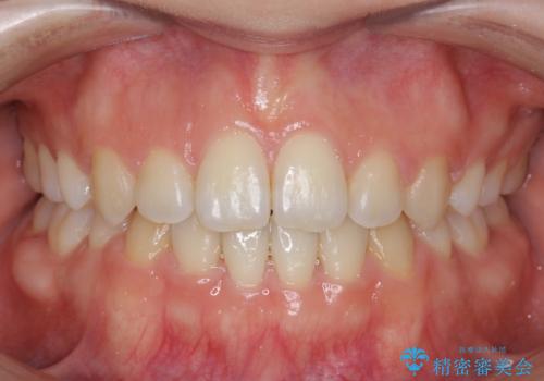 かみ合わせが悪いところを ワイヤー矯正でしっかり治療 マウスピース矯正は難しい症例の治療後