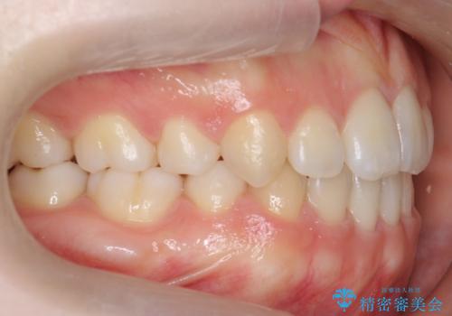 かみ合わせが悪いところを ワイヤー矯正でしっかり治療 マウスピース矯正は難しい症例の症例 治療後