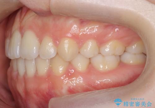 かみ合わせが悪いところを ワイヤー矯正でしっかり治療 マウスピース矯正は難しい症例の治療後
