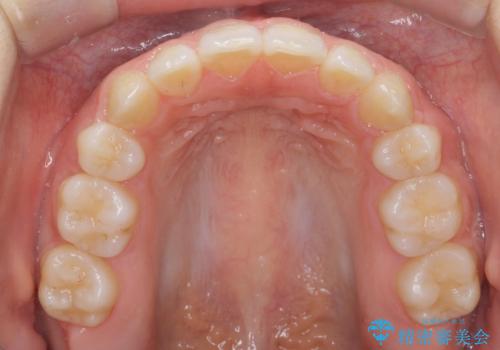かみ合わせが悪いところを ワイヤー矯正でしっかり治療 マウスピース矯正は難しい症例の治療後