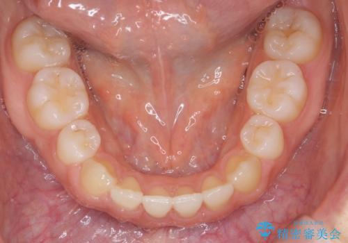 かみ合わせが悪いところを ワイヤー矯正でしっかり治療 マウスピース矯正は難しい症例の治療後