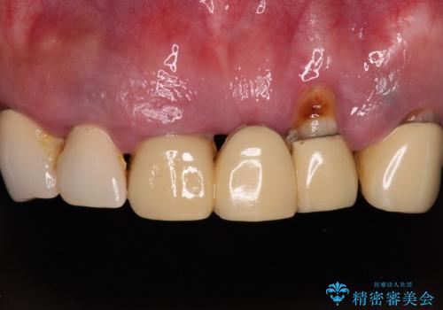 欠損と虫歯だらけの口の中　真っ白なセラミック治療の症例 治療前
