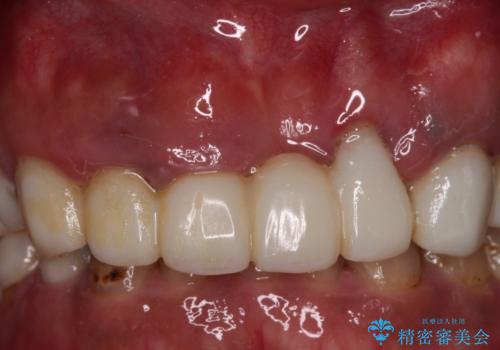 欠損と虫歯だらけの口の中　真っ白なセラミック治療の治療中