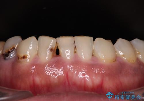 欠損と虫歯だらけの口の中　真っ白なセラミック治療の治療前