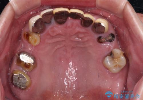 欠損と虫歯だらけの口の中 真っ白なセラミック治療の治療前