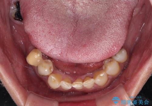 欠損と虫歯だらけの口の中 真っ白なセラミック治療の治療前