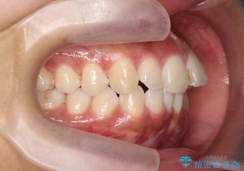 出っ歯感のある前歯を治したい、抜歯をしないマウスピース矯正の治療前