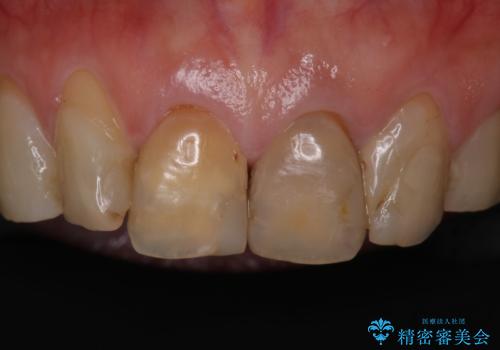 前歯の着色が気になる(失活歯)の症例 治療前