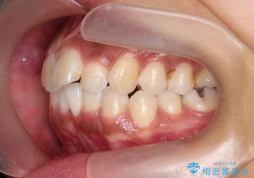 出っ歯感のある前歯を治したい、抜歯をしないマウスピース矯正の治療前
