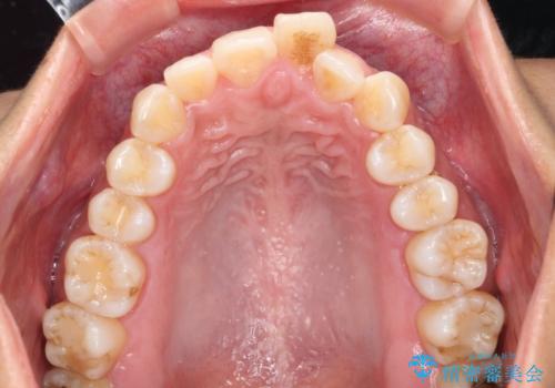 出っ歯感のある前歯を治したい、抜歯をしないマウスピース矯正の治療前