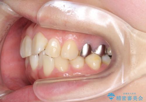 [ マウスピース矯正 ]  歯並びのずれが気になるの治療前